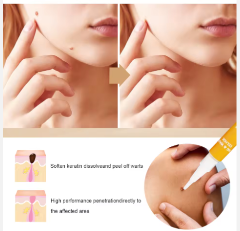 LAPIZ REMOVEDOR DE LUNARES Y VERRUGA 3ML