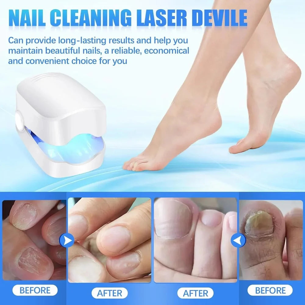 Láser para Uñas | Mejora la Apariencia de tus Uñas desde Casa