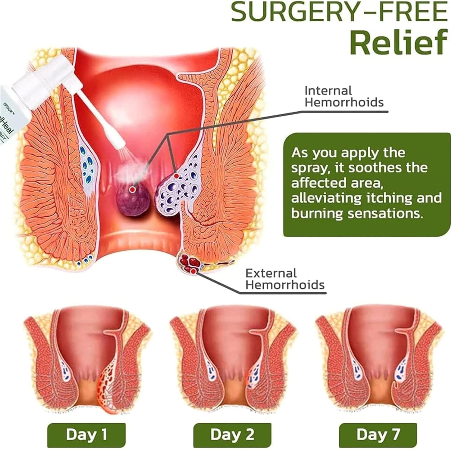 Spray Natural para Alivio de Hemorroides - a base de hierbas